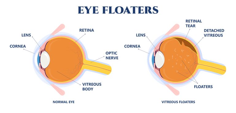 eye-floaters-south-carolina-retina-institute