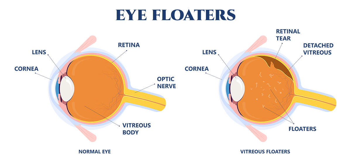 Eye Floaters In Children Causes And Concerns IVEWAP