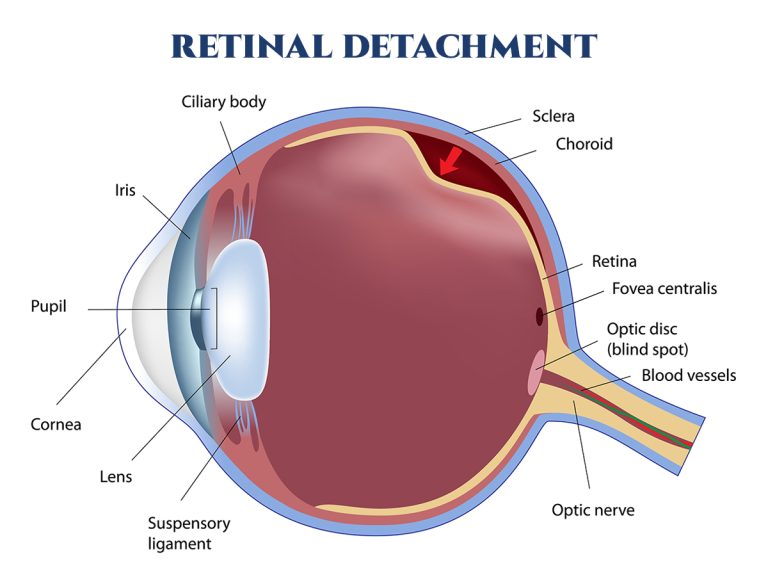 Retinal Detachment South Carolina Retina Institute