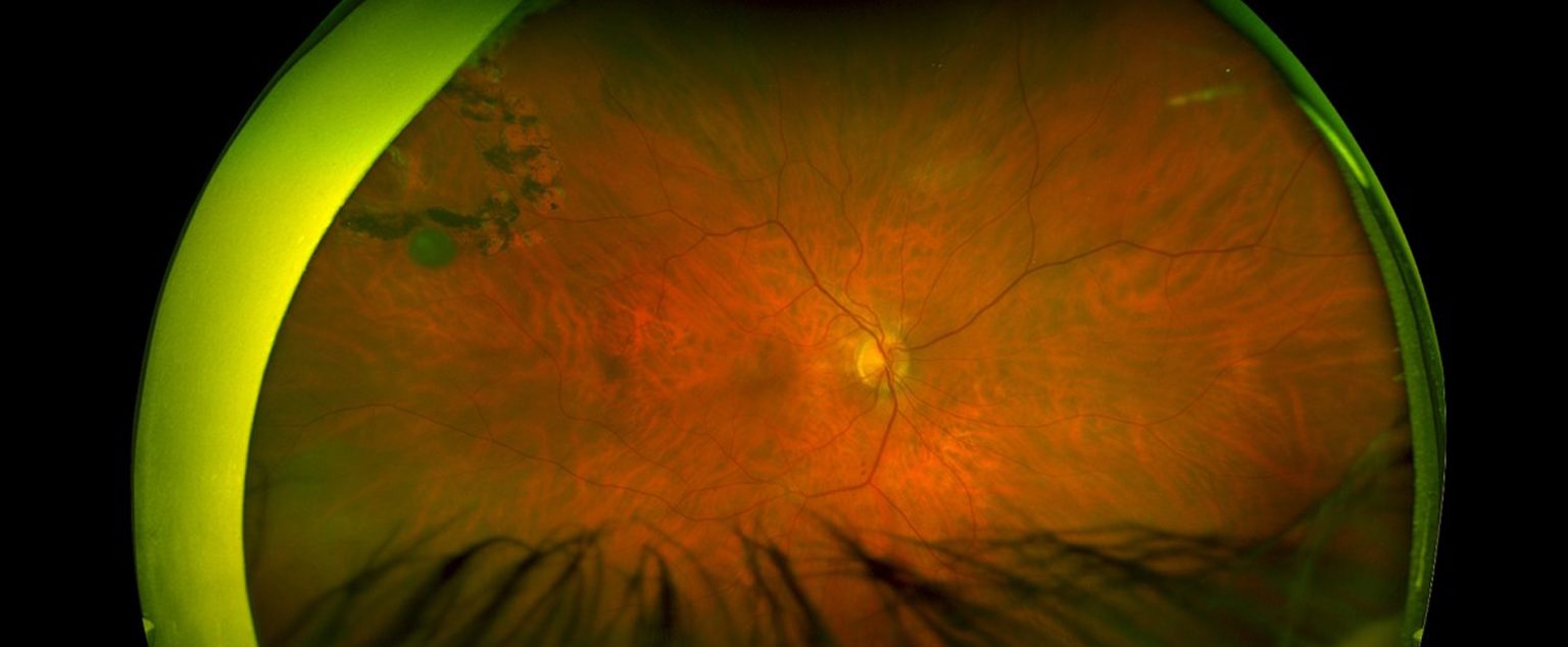 Retinal Holes & Tears | South Carolina Retina Institute LLC