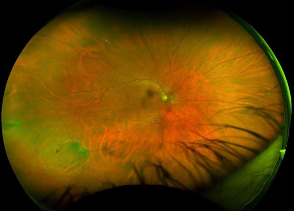 Retinal Holes And Tears South Carolina Retina Institute Llc