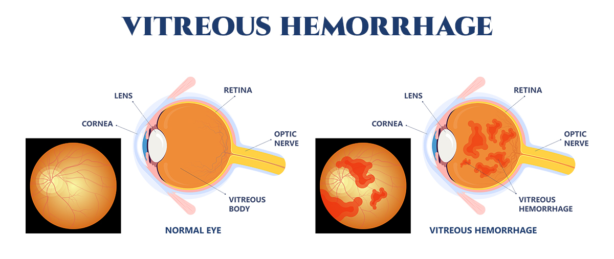 What Causes Vitreous Bleeding Retinal Vein Occlusion RVO Causes 